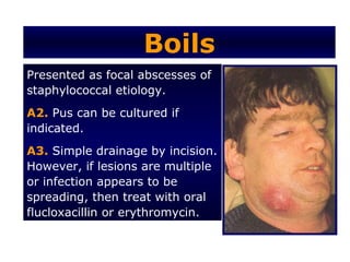 Boils
Presented as focal abscesses of
staphylococcal etiology.
A2. Pus can be cultured if
indicated.
A3. Simple drainage by incision.
However, if lesions are multiple
or infection appears to be
spreading, then treat with oral
flucloxacillin or erythromycin.
 