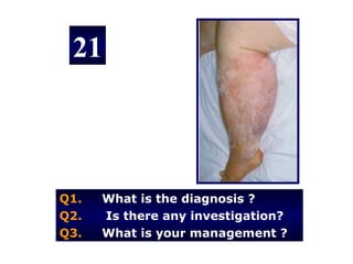 21



Q1.   What is the diagnosis ?
Q2.   Is there any investigation?
Q3.   What is your management ?
 