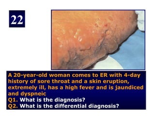 22



A 20-year-old woman comes to ER with 4-day
history of sore throat and a skin eruption,
extremely ill, has a high fever and is jaundiced
and dyspneic
Q1. What is the diagnosis?
Q2. What is the differential diagnosis?
 