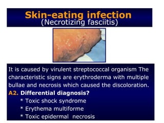 Skin-eating infection
           (Necrotizing fasciitis)




It is caused by virulent streptococcal organism The
characteristic signs are erythroderma with multiple
bullae and necrosis which caused the discoloration.
A2. Differential diagnosis?
     * Toxic shock syndrome
     * Erythema multiforme
     * Toxic epidermal necrosis
 