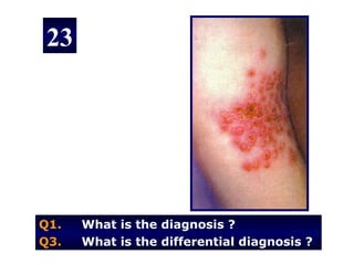 23




Q1.   What is the diagnosis ?
Q3.   What is the differential diagnosis ?
 