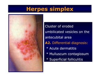 Herpes simplex


     Cluster of eroded
     umbilicated vesicles on the
     antecubital area
     A2. Differential diagnosis:
     * Acute dermatitis
     * Mulluscum contagiosum
     * Superficial folliculitis
 