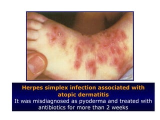 Herpes simplex infection associated with
                atopic dermatitis
It was misdiagnosed as pyoderma and treated with
        antibiotics for more than 2 weeks
 