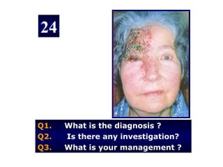 24




Q1.   What is the diagnosis ?
Q2.   Is there any investigation?
Q3.   What is your management ?
 