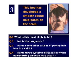 3
           This boy has
           developed a
           smooth round
           bald patch on
           the scalp.



Q.1 What is this most likely to be ?
Q.2   hat is the prognosis ?
Q.3   Name some other causes of patchy hair
   loss in a child ?
Q.4   Name three systemic diseases in which
   non-scarring alopecia may occur ?
 