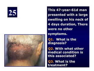 This 47-year-61d man
25   presented with a large
     swelling on his neck of
     4 days duration, There
     were no other
     symptoms.
     Q1. What is the
     diagnosis?
     Q2. With what other
     medical condition is
     this associated?
     Q3. What is the
     treatment?
 