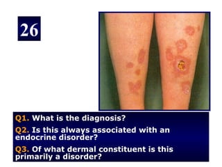 26



Q1. What is the diagnosis?
Q2. Is this always associated with an
endocrine disorder?
Q3. Of what dermal constituent is this
primarily a disorder?
 