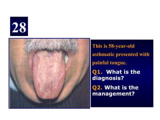 28
     This is 58-year-old
     asthmatic presented with
     painful tongue.
     Q1. What is the
     diagnosis?
     Q2. What is the
     management?
 