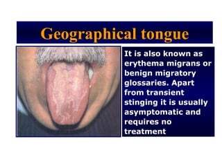 Geographical tongue
          It is also known as
          erythema migrans or
          benign migratory
          glossaries. Apart
          from transient
          stinging it is usually
          asymptomatic and
          requires no
          treatment
 
