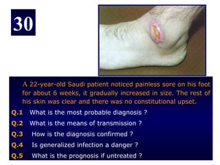 30

  A 22-year-old Saudi patient noticed painless sore on his foot
  for about 6 weeks, it gradually increased in size. The rest of
  his skin was clear and there was no constitutional upset.
Q.1   What is the most probable diagnosis ?
Q.2   What is the means of transmission ?
Q.3   How is the diagnosis confirmed ?
Q.4   Is generalized infection a danger ?
Q.5   What is the prognosis if untreated ?
 