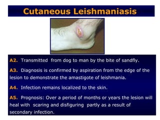 Cutaneous Leishmaniasis




A2. Transmitted from dog to man by the bite of sandfly.

A3. Diagnosis is confirmed by aspiration from the edge of the
lesion to demonstrate the amastigote of leishmania.

A4. Infection remains localized to the skin.

A5. Prognosis: Over a period of months or years the lesion will
heal with scaring and disfiguring partly as a result of
secondary infection.
 