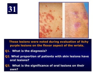 31


  These lesions were noted during evaluation of itchy
  purple lesions on the flexor aspect of the wrists.

Q1. What is the diagnosis?

Q2. What proportion of patients with skin lesions have
   oral lesions?

Q3. What is the significance of oral lesions on their
   own?
 