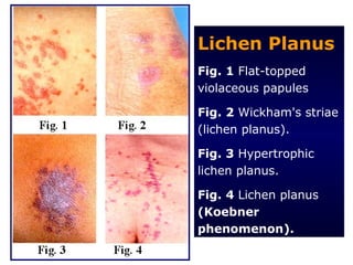 Lichen Planus
Fig. 1 Flat-topped
violaceous papules

Fig. 2 Wickham's striae
(lichen planus).

Fig. 3 Hypertrophic
lichen planus.

Fig. 4 Lichen planus
(Koebner
phenomenon).
 