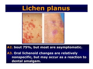 Lichen planus




A2. bout 75%, but most are asymptomatic.
A3. Oral lichenoid changes are relatively
  nonspecific, but may occur as a reaction to
  dental amalgam.
 