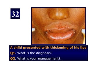 32



A child presented with thickening of his lips
Q1. What is the diagnosis?
Q2. What is your management?.
 