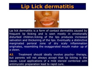 Lip Lick dermatitis



Lip lick dermatitis is a form of contact dermatitis caused by
frequent lip llicking and is seen mostly in emotionally
disturbed children.licking of the lips produces increased
salivation and thickening of the lips. Eventually a distinctive
marginated perioral zone of dry scaly inflammation
originates, resembling the exaggerated mouth make- up of
a clown.
A2.    Treatment should ideally involve psycho- therapy,
but parents will not always accept that lip licking is the
cause. Local applications of a mild steroid combined with
antimycotic preparation lead to rapid cure.
 