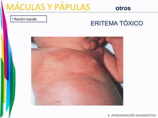 4. APROXIMACIÓN DIAGNÓSTICA
MÁCULAS Y PÁPULAS
• Recién nacido
ERITEMA TÓXICO
otros
 