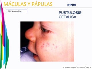 4. APROXIMACIÓN DIAGNÓSTICA
MÁCULAS Y PÁPULAS
• Recién nacido
PUSTULOSIS
CEFÁLICA
otros
 