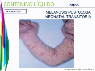 4. APROXIMACIÓN DIAGNÓSTICA
CONTENIDO LÍQUIDO
• Recién nacido
MELANOSIS PUSTULOSA
NEONATAL TRANSITORIA
otros
 