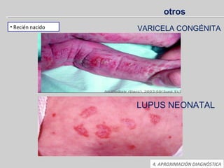 4. APROXIMACIÓN DIAGNÓSTICA
• Recién nacido VARICELA CONGÉNITA
LUPUS NEONATAL
otros
 