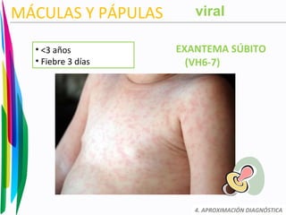 MÁCULAS Y PÁPULAS
EXANTEMA SÚBITO
(VH6-7)
4. APROXIMACIÓN DIAGNÓSTICA
• <3 años
• Fiebre 3 días
viral
 