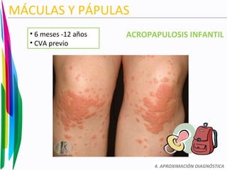 MÁCULAS Y PÁPULAS
ACROPAPULOSIS INFANTIL
4. APROXIMACIÓN DIAGNÓSTICA
• 6 meses -12 años
• CVA previo
 