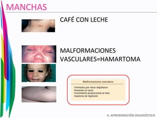 CAFÉ CON LECHE
MALFORMACIONES
VASCULARES=HAMARTOMA
4. APROXIMACIÓN DIAGNÓSTICA
MANCHAS
 