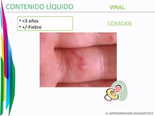 COXACKIE
CONTENIDO LÍQUIDO
4. APROXIMACIÓN DIAGNÓSTICA
VIRAL
• <3 años
• +/-Fiebre
 