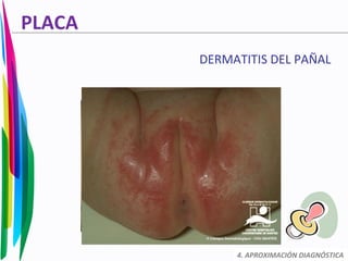 PLACA
DERMATITIS DEL PAÑAL
4. APROXIMACIÓN DIAGNÓSTICA
 