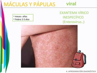 MÁCULAS Y PÁPULAS
EXANTEMA VÍRICO
INESPECÍFICO
(Enterovirus..)
4. APROXIMACIÓN DIAGNÓSTICA
• meses- años
• Fiebre 2-5 días
viral
 