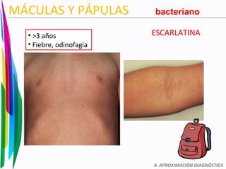 ESCARLATINA
4. APROXIMACIÓN DIAGNÓSTICA
MÁCULAS Y PÁPULAS
• >3 años
• Fiebre, odinofagia
bacteriano
 