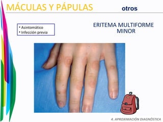 ERITEMA MULTIFORME
MINOR
4. APROXIMACIÓN DIAGNÓSTICA
MÁCULAS Y PÁPULAS
• Asintomático
• Infección previa
otros
 