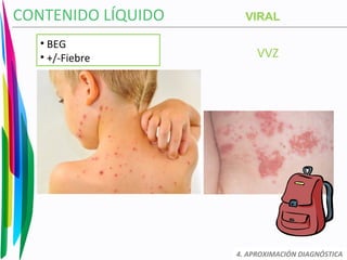 VVZ
CONTENIDO LÍQUIDO
4. APROXIMACIÓN DIAGNÓSTICA
VIRAL
• BEG
• +/-Fiebre
 