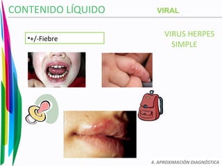 VIRUS HERPES
SIMPLE
CONTENIDO LÍQUIDO
4. APROXIMACIÓN DIAGNÓSTICA
VIRAL
•+/-Fiebre
 