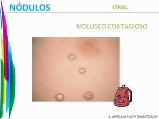 NÓDULOS
MOLUSCO CONTAGIOSO
4. APROXIMACIÓN DIAGNÓSTICA
VIRAL
 