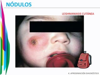 NÓDULOS
LEISHMANIASIS CUTÁNEA
4. APROXIMACIÓN DIAGNÓSTICA
 
