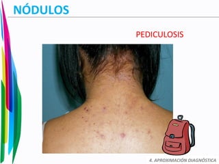 NÓDULOS
PEDICULOSIS
4. APROXIMACIÓN DIAGNÓSTICA
 