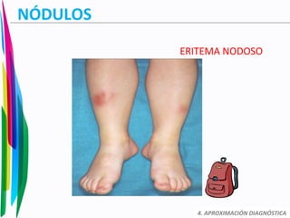 NÓDULOS
ERITEMA NODOSO
4. APROXIMACIÓN DIAGNÓSTICA
 
