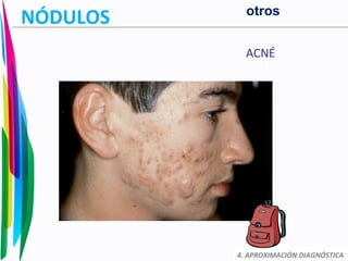 NÓDULOS
ACNÉ
4. APROXIMACIÓN DIAGNÓSTICA
otros
 