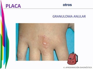 PLACA
GRANULOMA ANULAR
4. APROXIMACIÓN DIAGNÓSTICA
otros
 
