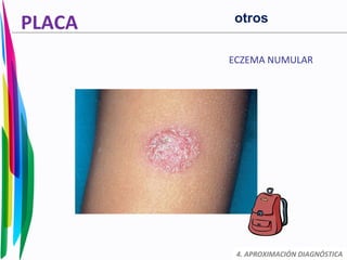 PLACA
ECZEMA NUMULAR
4. APROXIMACIÓN DIAGNÓSTICA
otros
 