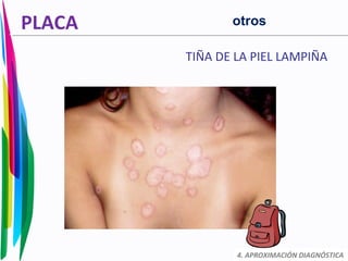 PLACA
TIÑA DE LA PIEL LAMPIÑA
4. APROXIMACIÓN DIAGNÓSTICA
otros
 