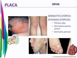 PLACA
DERMATITIS ATÓPICA
ESTIGMAS ATÓPICOS:
– Pitiriasis alba
– Dermatosis plantar
juvenil
– Dermatitis perioral
4. APROXIMACIÓN DIAGNÓSTICA
otros
 