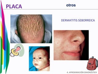 PLACA
DERMATITIS SEBORREICA
4. APROXIMACIÓN DIAGNÓSTICA
otros
 