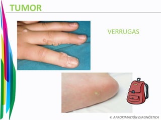 TUMOR
VERRUGAS
4. APROXIMACIÓN DIAGNÓSTICA
 