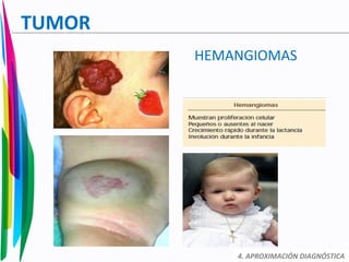 TUMOR
HEMANGIOMAS
4. APROXIMACIÓN DIAGNÓSTICA
 