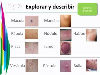Explorar y describir
Mácula Mancha
Pápula Nódulo Habón
Placa Tumor
Vesícula Pústula Bulla
Lesiones
primarias
Lesiones
primarias
 