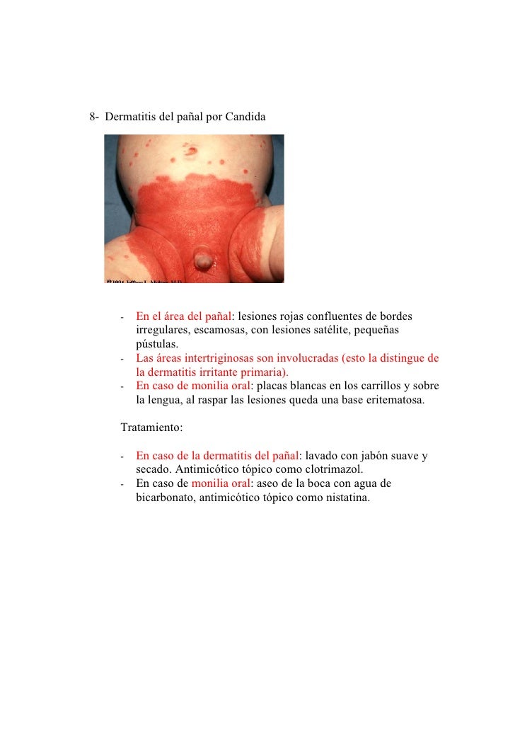 Ornit 21 ungüento de la psoriasis