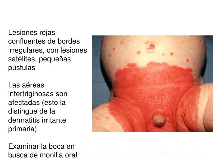Artropatichesky la psoriasis el ungüento