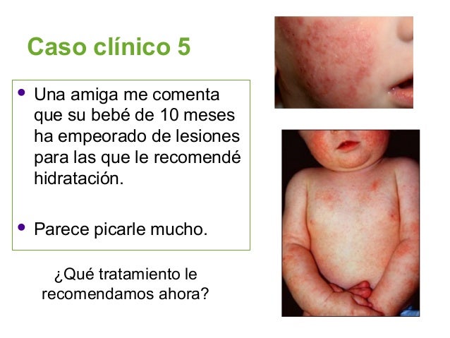 La pintura de los cabello a la psoriasis sobre la cabeza